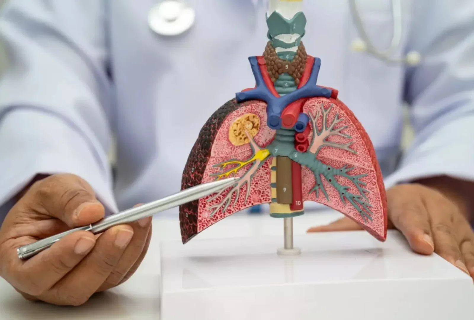 Teste acessível pode apontar quem se beneficia de imunoterapia no câncer de pulmão