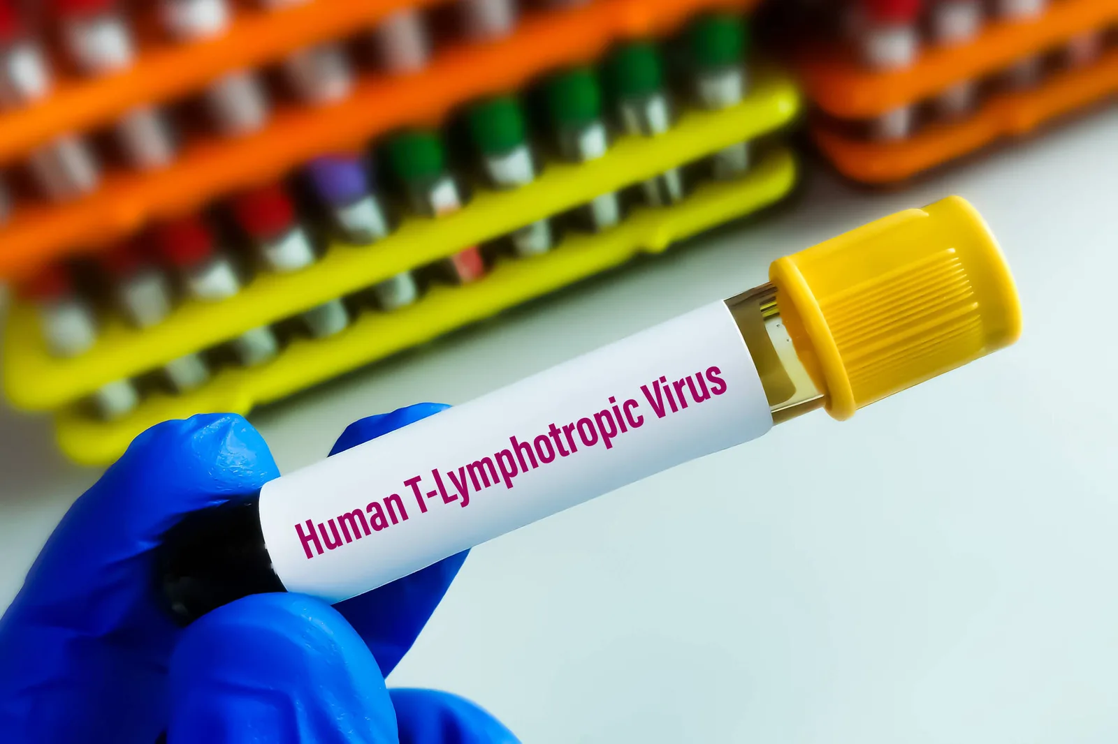 Estudo identifica síndrome inflamatória em portadores assintomáticos de HTLV-1