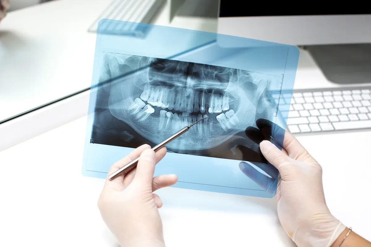 Dentes de leite mostram 19 substâncias em concentrações maiores em crianças com autismo
