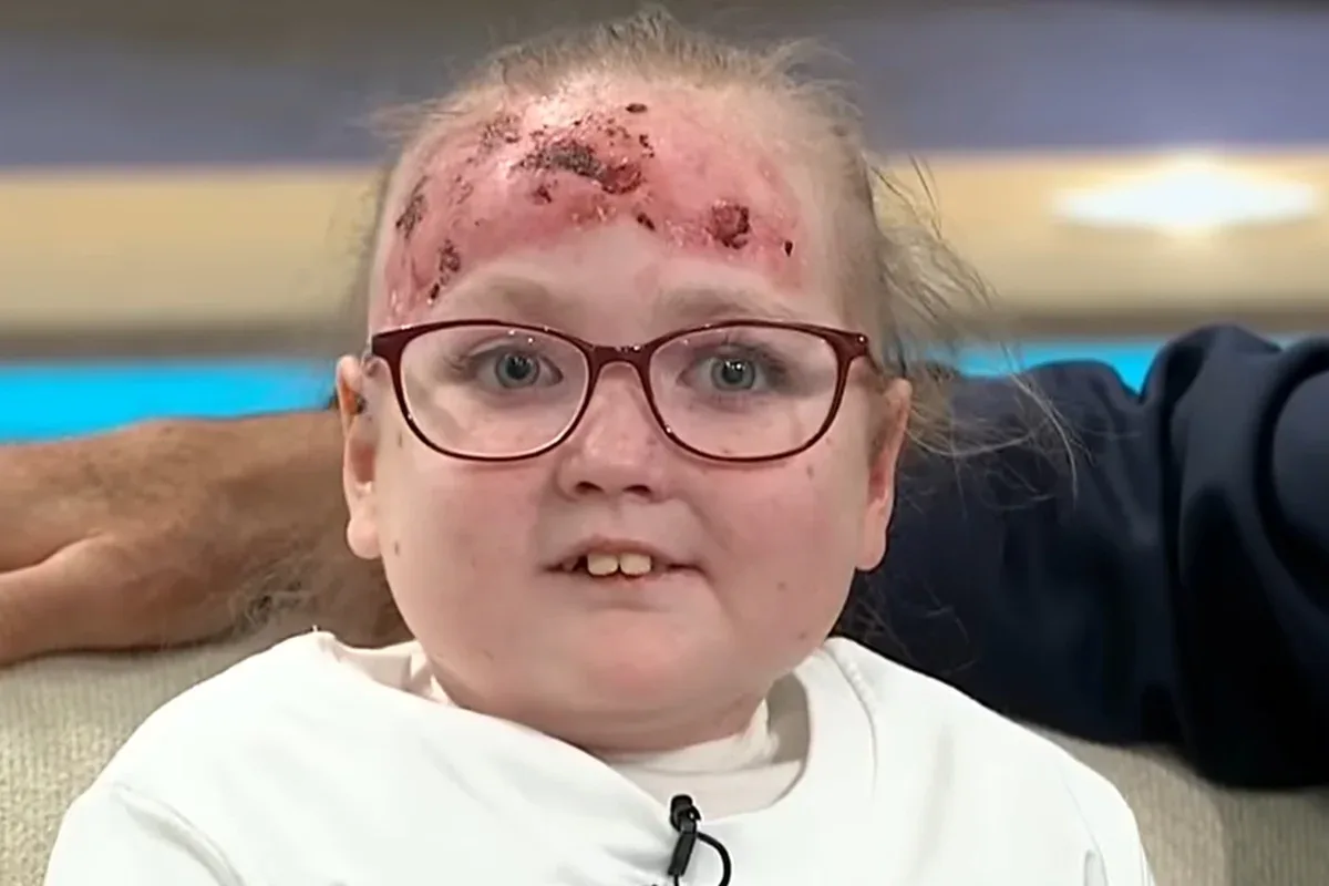 Jasmine Ritchie relata impacto da epidermólise bolhosa na rotina escolar