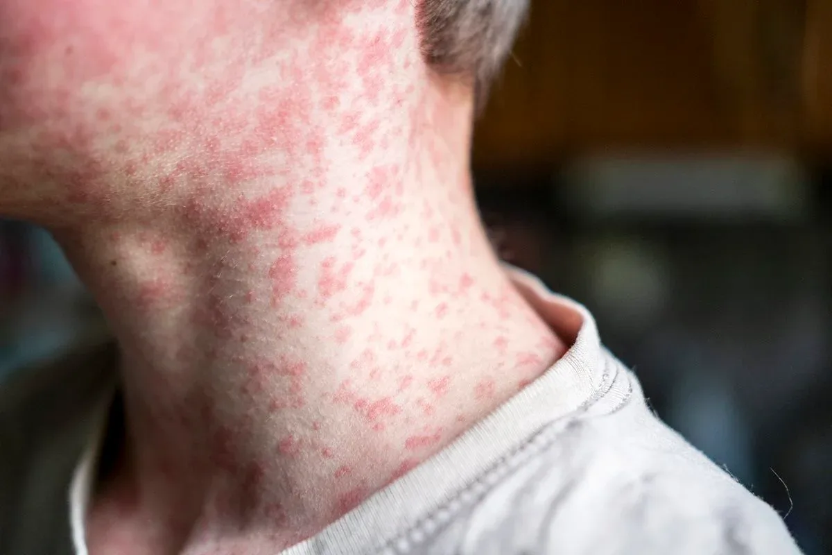 Nova York amplia vacinação após declarar emergência por sarampo