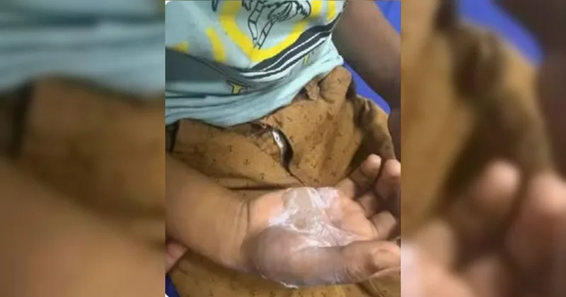 Dois irmãos são retirados de casa após criança sofrer queimaduras em Goiás