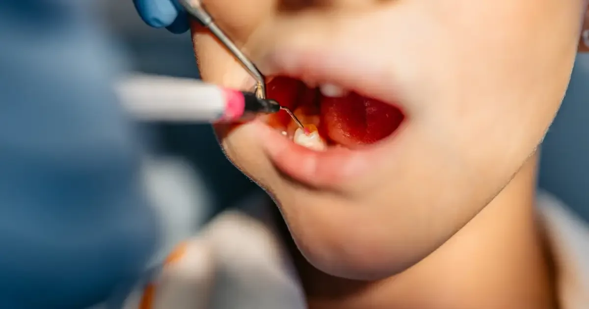 Atendimentos odontológicos infantis atingem maior volume aos 13 anos