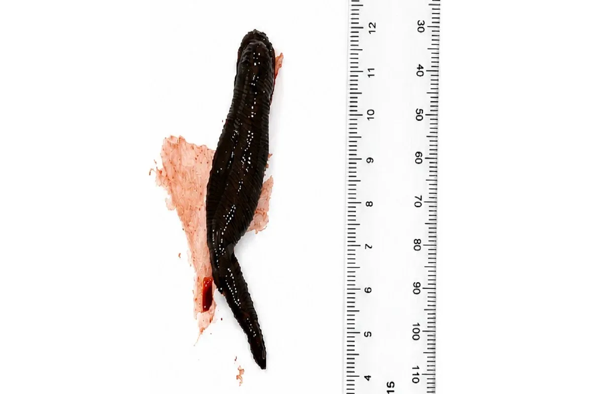 Sanguessuga de 8 cm é retirada da garganta de menina após uma semana